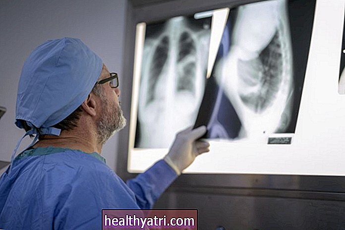DNK test može brzo dijagnosticirati upalu pluća u teško bolesnih bolesnika s COVID-19