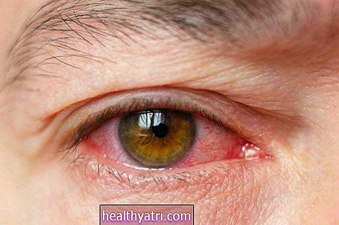 Je ružové oko príznakom COVID-19?