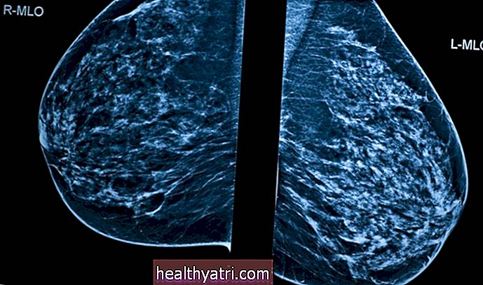 Natečeni limfni čvorovi nakon cjepiva protiv COVID-19 mogu uzrokovati zbunjenost mamografom
