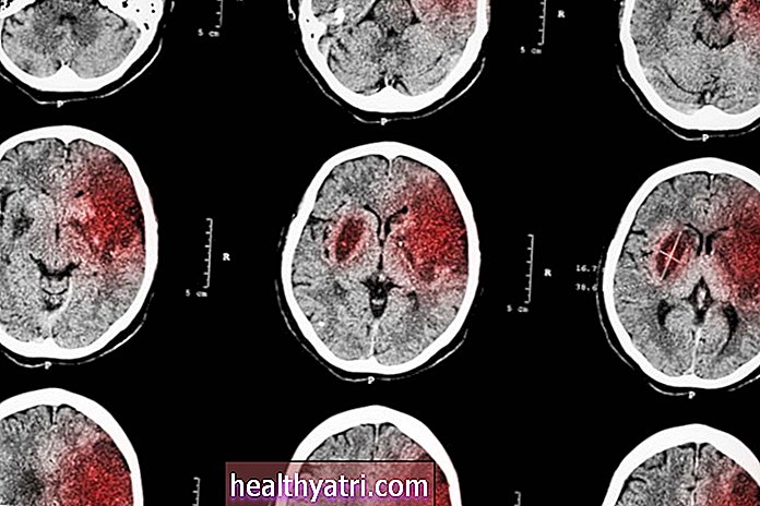 Yhteys koronaviruksen ja aivohalvauksen välillä