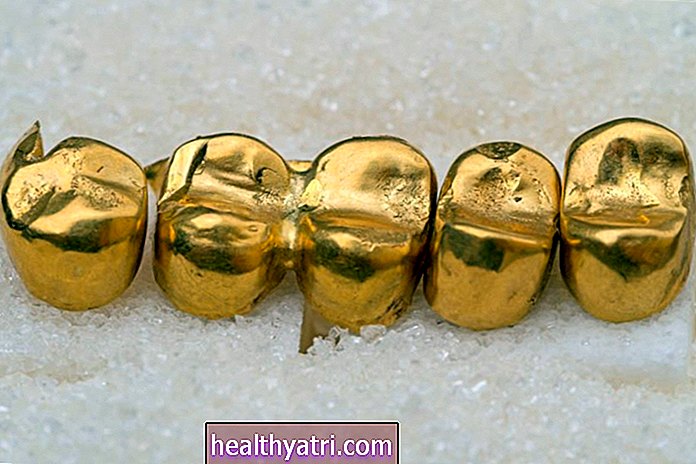 Kuldsed hambakroonid