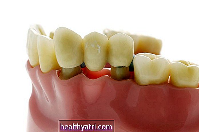 Τι είναι η οδοντιατρική γέφυρα;