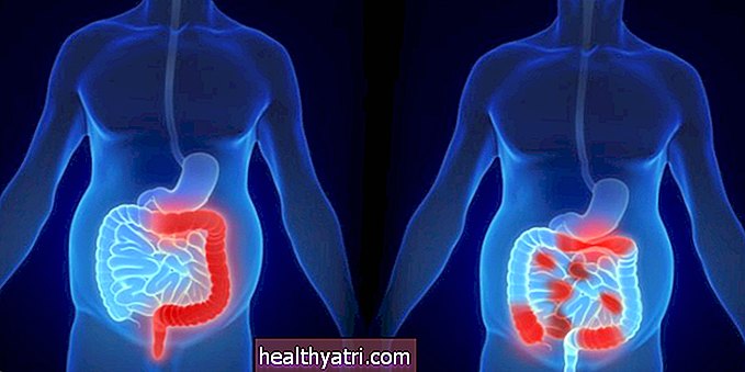 Diferencias entre la colitis ulcerosa y la enfermedad de Crohn