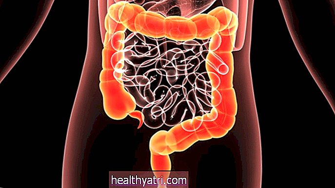 Colitis fulminante: cuando el colon se vuelve tóxico