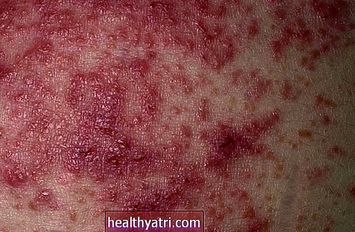 Kuidas Herpetiformise dermatiit välja näeb
