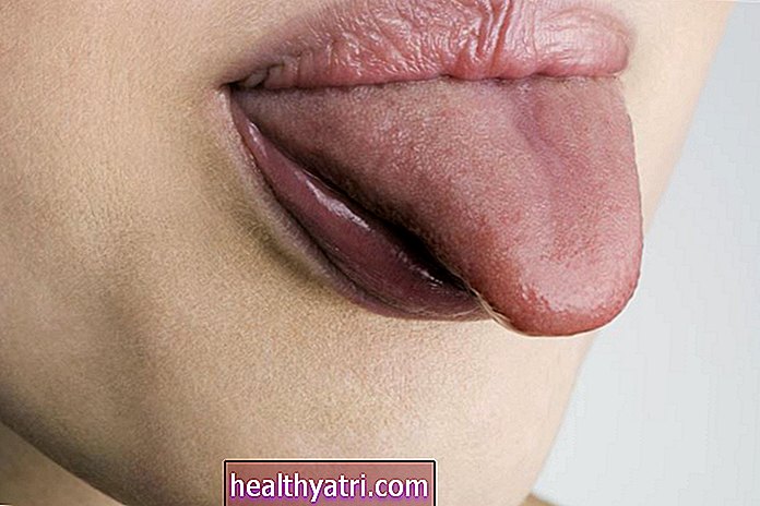 Kas sukelia patinę liežuvį?