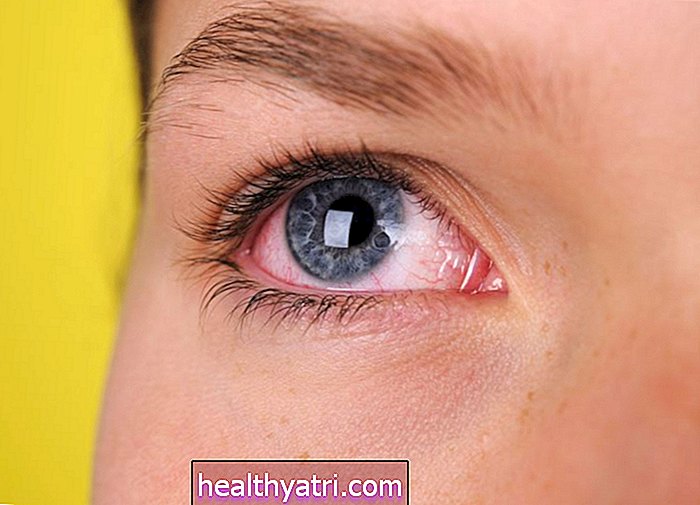 Síntomas del ojo rosado (conjuntivitis)