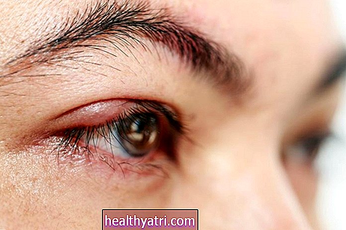 Behandling og symptomer på stye i øyelokket