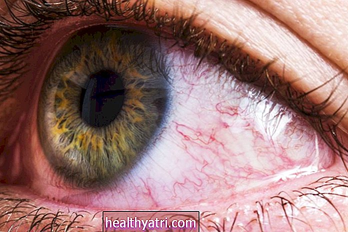 Hva er øyelymfom?