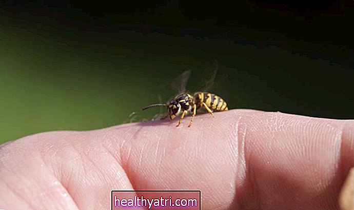 Como tratar uma picada de abelha com segurança