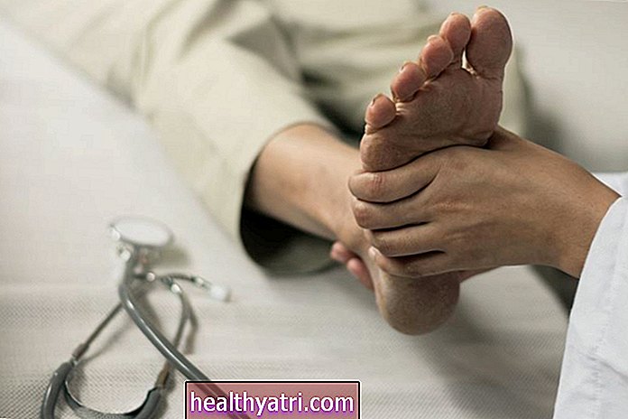 Αιτίες των οστών Spurs στα πόδια και τη θεραπεία