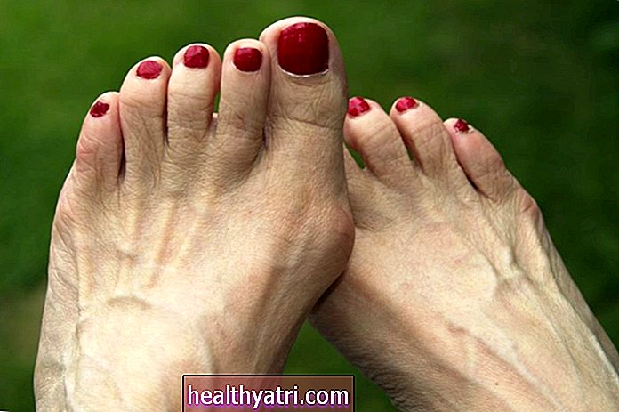 Σησαμοειδίτιδα και πόνος στα δάχτυλα των ποδιών