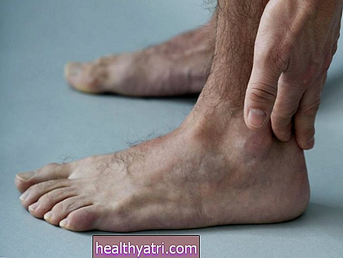 Zapalenie ścięgna stopy i kostki