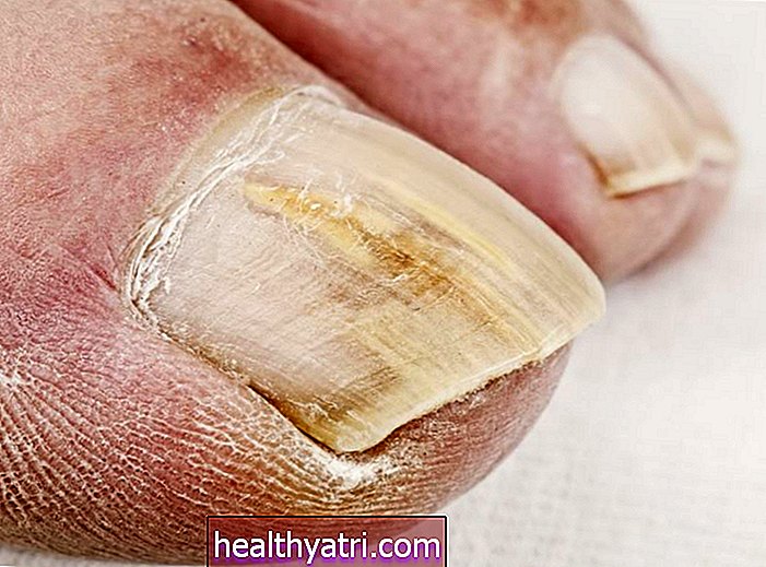 Tratamientos tópicos para hongos en las uñas de los pies