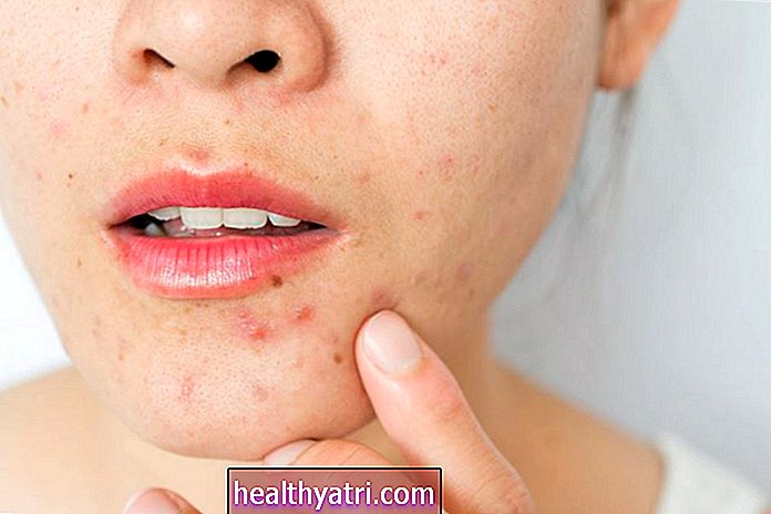 10 años de estudios relacionan los brotes de acné con la dieta