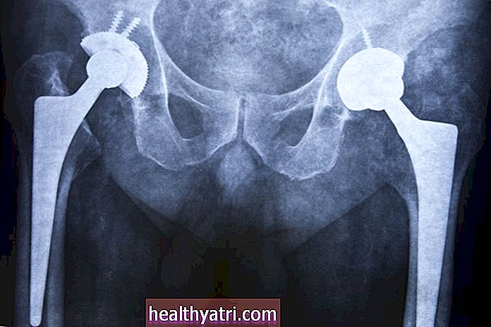 Obat Anti Inflamasi Dapat Membantu Penderita Osteoartritis Menghindari Penggantian Sendi