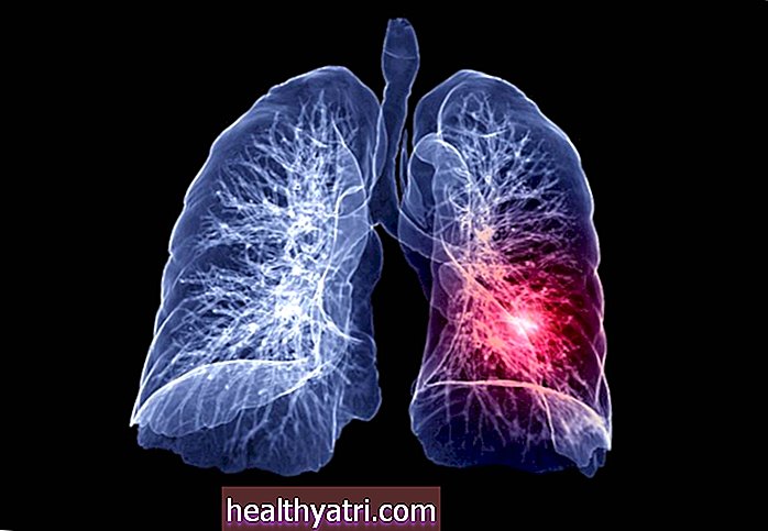 Raport: Cazuri de cancer pulmonar, decese în declin în S.U.A.