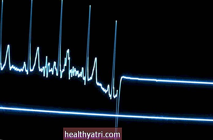 Cách điều trị Nhịp tim nhanh trên diện rộng và hẹp