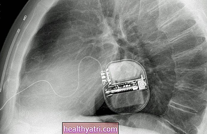 Vai jums vajadzētu saņemt implantējamu defibrilatoru?