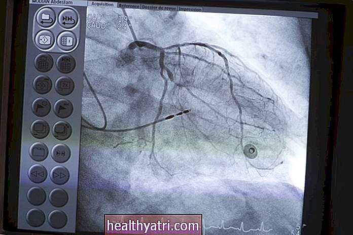 ¿Qué es el cateterismo cardíaco?
