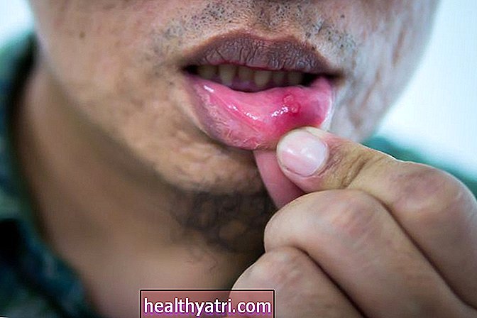 HIV και πληγές στο στόμα