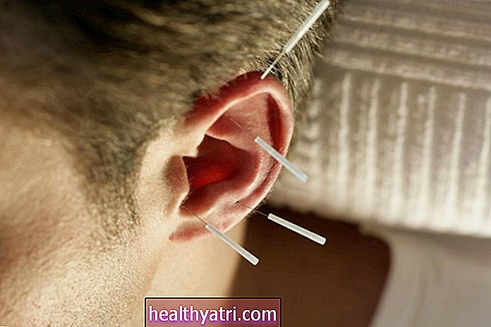 Οφέλη για την υγεία του βελονισμού στο αυτί