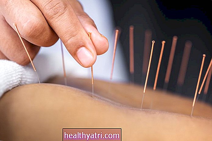 Quanto costa il trattamento di agopuntura?