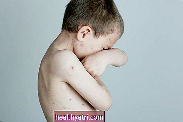 Prednisona y otros esteroides para niños