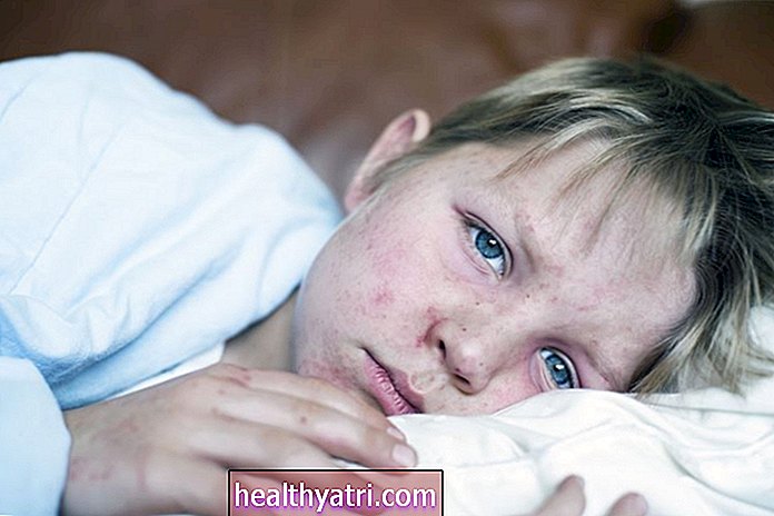 Дети-Здравствени - Симптоми оспица