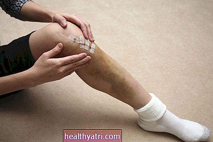 Manfaat Penggantian Lutut Minimum Invasif