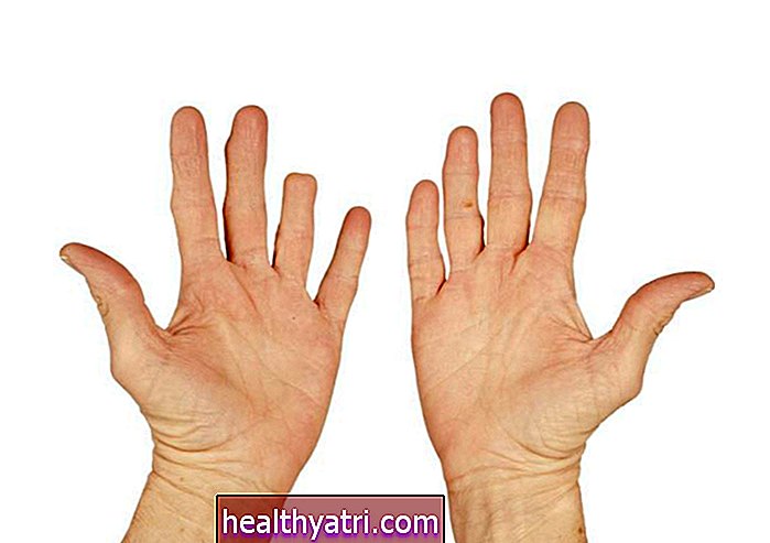 Reinserción de la amputación del dedo o pulgar