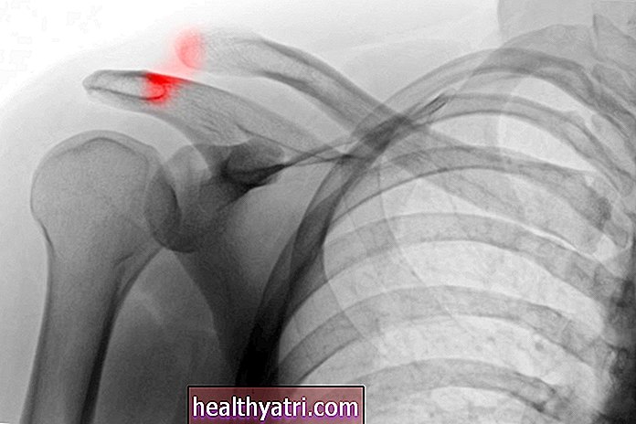 Causas, síntomas y tratamientos de la separación del hombro