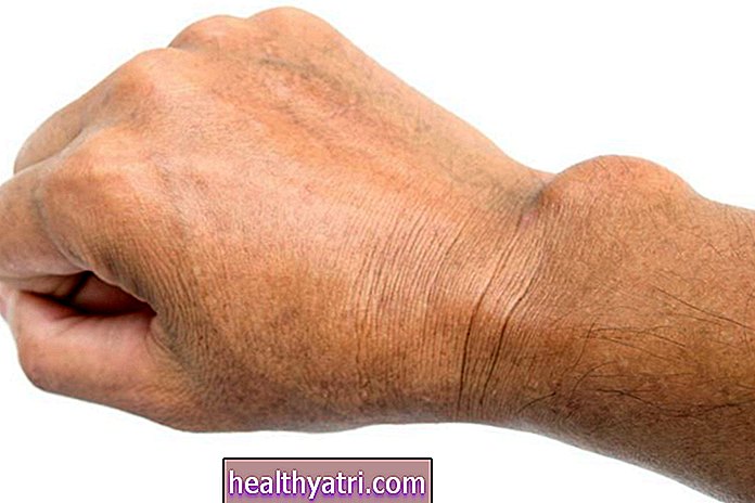 Simptomi, vrste i prognoza tumora ruku