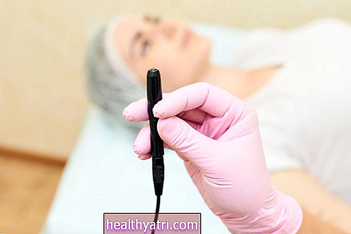 Depilación permanente para mujeres con síndrome de ovario poliquístico