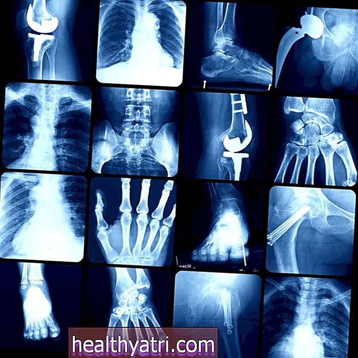 Apa itu Osteopetrosis?