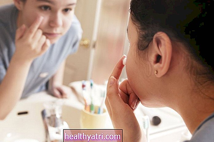 5 formas de preservar su autoestima a pesar del acné
