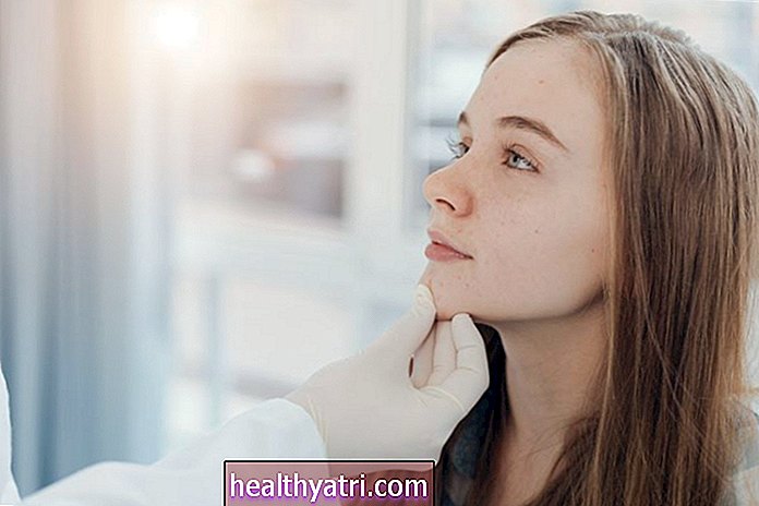 7 señales de que su adolescente debe consultar a un dermatólogo para el acné