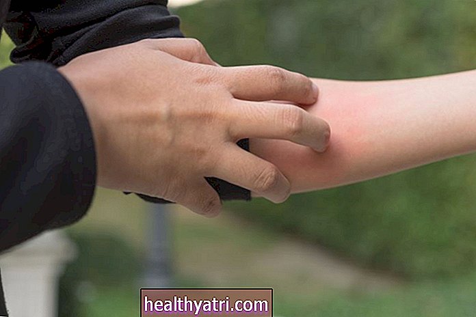 Yleiskatsaus allergiseen kosketusihottumaan
