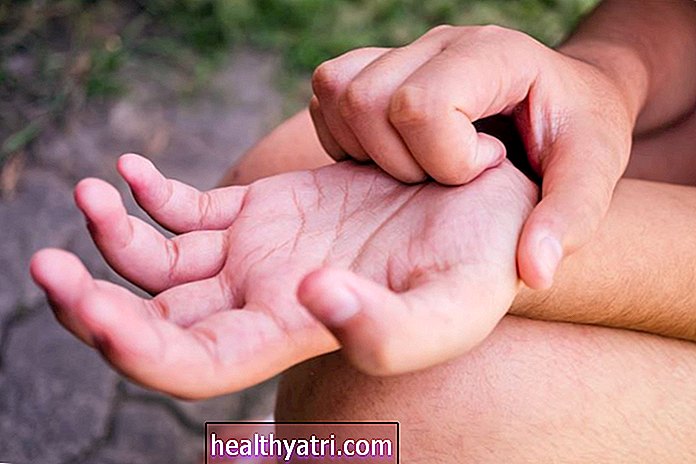 En oversikt over psoriasis i hender og føtter