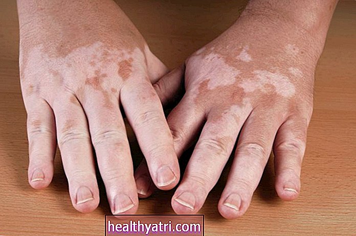 Prehľad vitiliga