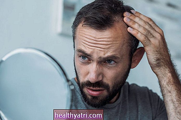 A frontális rostos alopecia (FFA) okai és kezelése