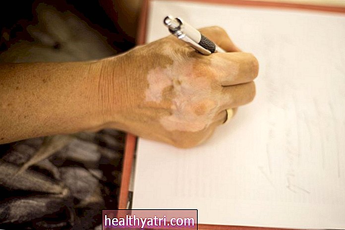 Causas y tratamientos para la decoloración de la piel