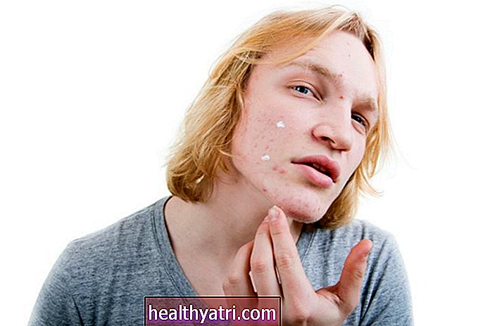Cómo trata Duac el acné