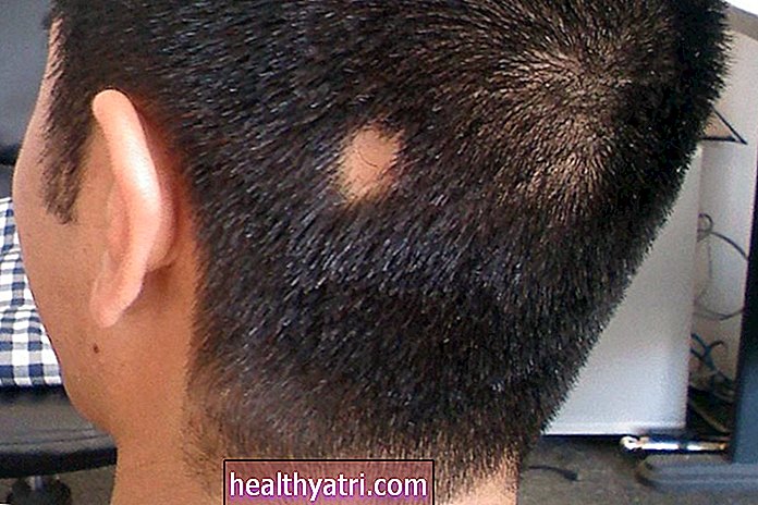 Φυσικές θεραπείες για Alopecia Areata