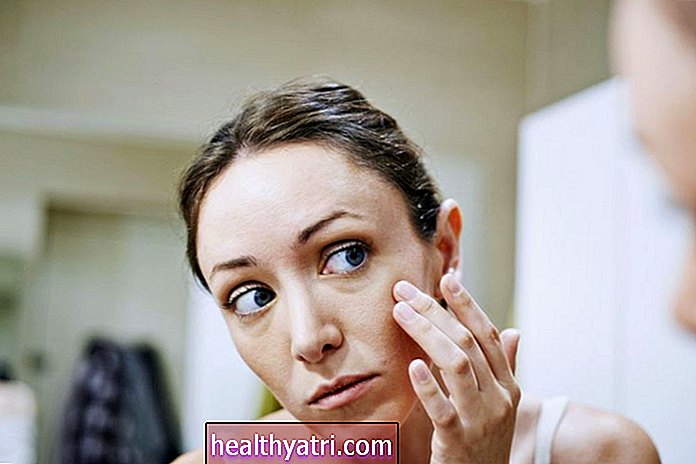 Opciones de medicación oral para el acné