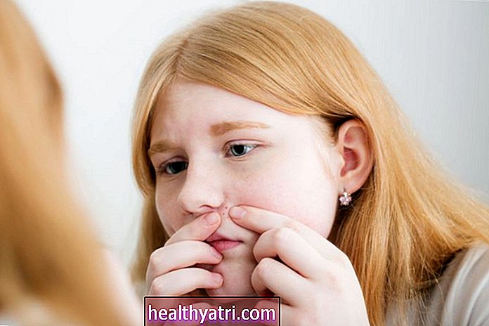 Ajutor pentru adolescenți pentru acnee