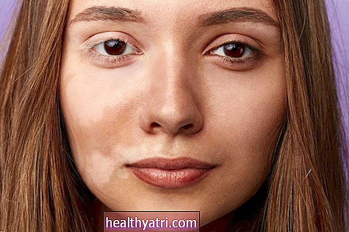 Kas yra odos pigmentacijos sutrikimai?