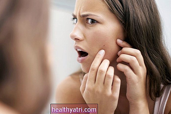 Cuándo consultar a un dermatólogo para tratar el acné