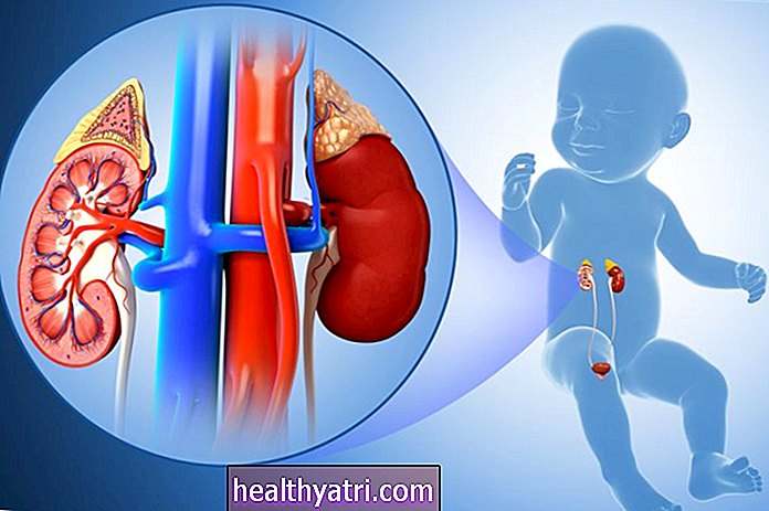 Urológica-Salud - Una descripción general del riñón displásico multiquístico