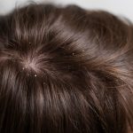 Banishing Dandruff: Simple and Natural Solutions That Work